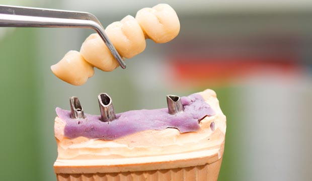 Prothèse dentaire sur implants