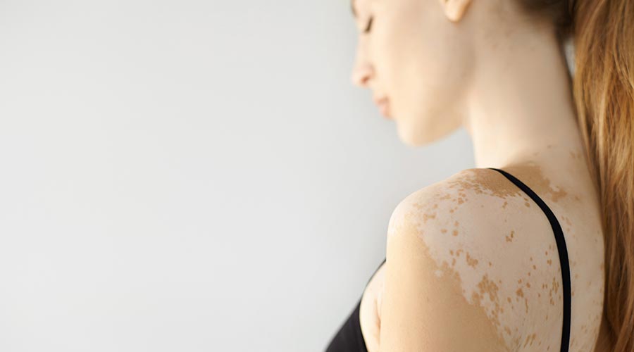 Qu'est-ce que le vitiligo et comment peut-on le traiter?