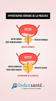 Hypertrophie bénigne de la prostate (HBP)