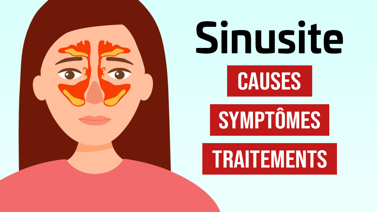 Sinusite : causes, symptômes et traitements